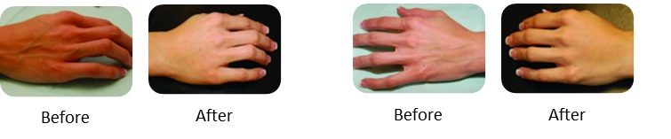 Before and After Glytone Hand Peel