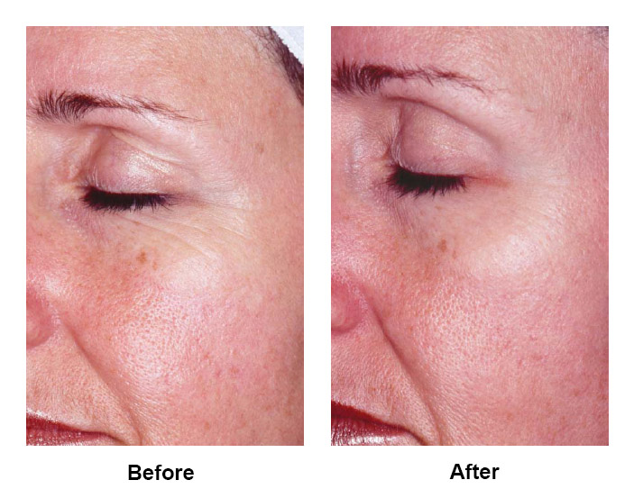 After 14 Days of Twice Daily Use (Neocutis Eye Care)