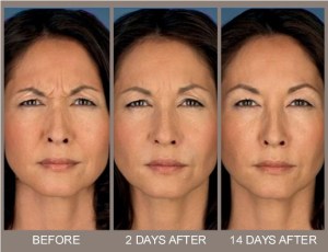 BOTOX-before-and-after-photos