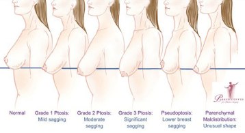 breast-lift-diagram-ptosis11