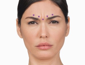 glabella